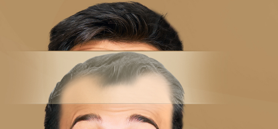 Searching a solution for baldness?