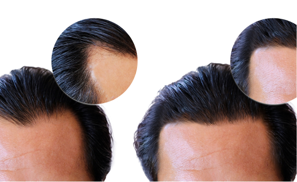 Hair Transplant